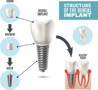 This is the image for the news article titled Dental Implants